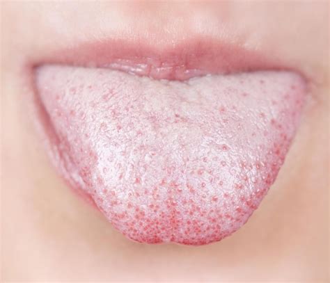 White Tongue Symptoms Causes Treatment