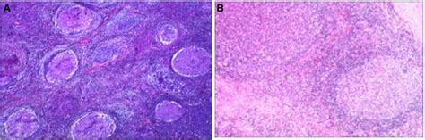 A Hyperplasia Of Lymphoid Follicular Tissue In Lymph Nodes B