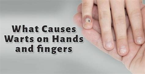 What Causes Warts On Hands Fingers Feet And Toes