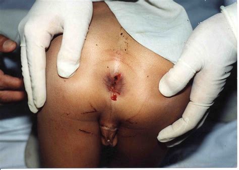Bruised Penis After Sex Porno Mana Sex
