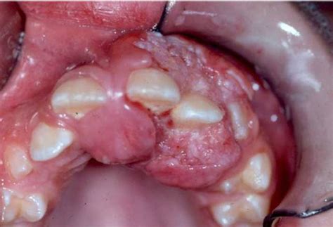 Pdf Oral Squamous Cell Carcinoma In Children Review Of An Unusual