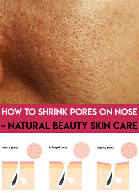 How To Get Rid Of Open Pores On Nose 3 Ways To Remove Blackheads On