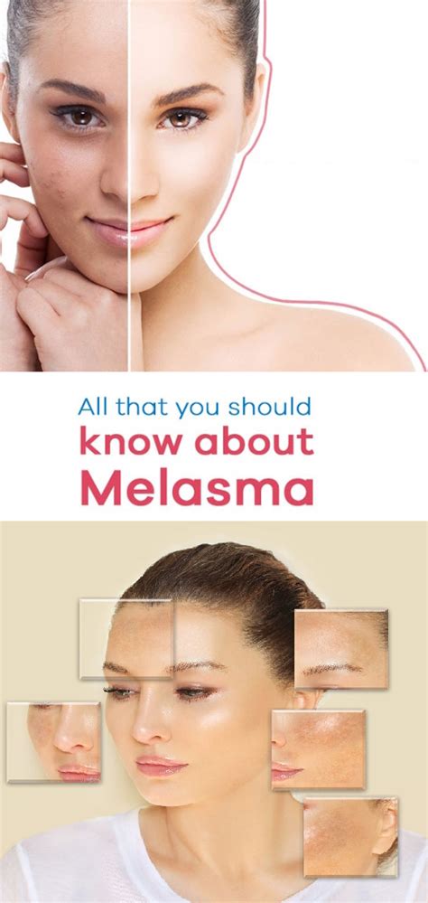 Understanding Melasma Its Causes Symptoms And Recommended Treatments