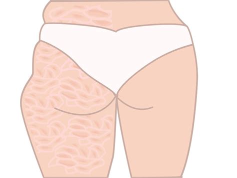 9 Simple Exercises To Get Rid Of Cellulite On Buttocks