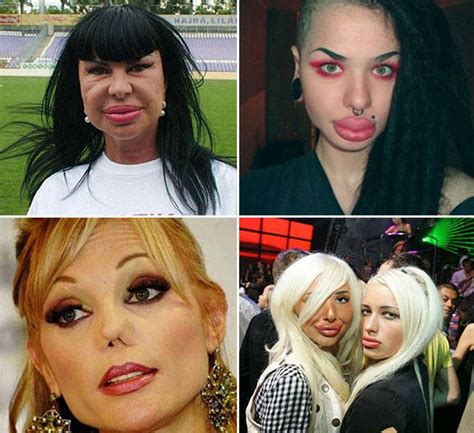 Irreversible Plastic Surgery Fails That Are Straight Up Scary 39 Pics