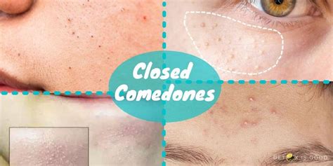 Pimples can occur anywhere on the face and forehead. How to Get Rid of Closed Comedones? (+ Natural Remedies)