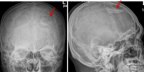 Depressed Skull Fracture Radiology Cases