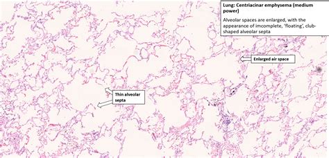 Emphysema Histology Labeled