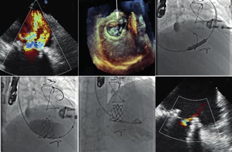 A Transesophageal Echocardiogram Tee Showing Severe Tricuspid