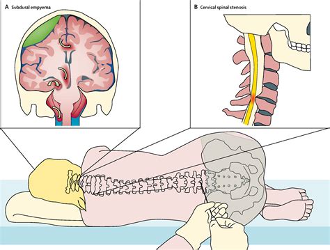 Technological Advances And Changing Indications For Lumbar Puncture In