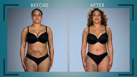 Photos From Botched Patients Before And After Shocking Transformations E Online