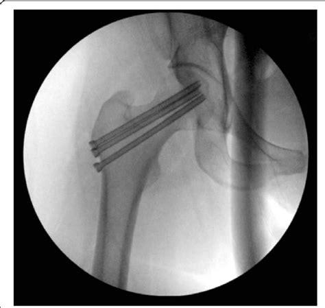 Intraoperative Fluoroscopic Radiograph Of The Right Hip Demonstrating