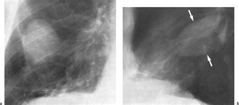 It can result from pneumonia and many other conditions. Alveolar Infiltrates and Atelectasis | Radiology Key