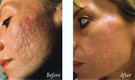 Use Tca To Remove Acne Scars Hubpages
