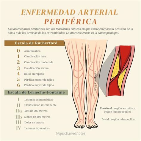 Enfermedad Arterial Periférica Quickmednotes Udocz