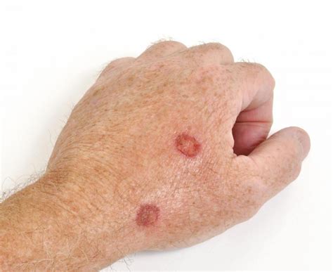 Figo 15 Elenchi Di Melanoma Skin Cancer On Finger Sunlight Contains