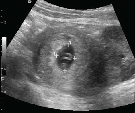 Intrauterine Pregnancy With Crown Rump Length Cm Consistent With Download Scientific