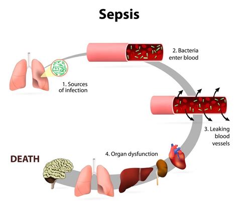 What Are The 3 Stages Of Sepsis Sepsis Severe I Shock