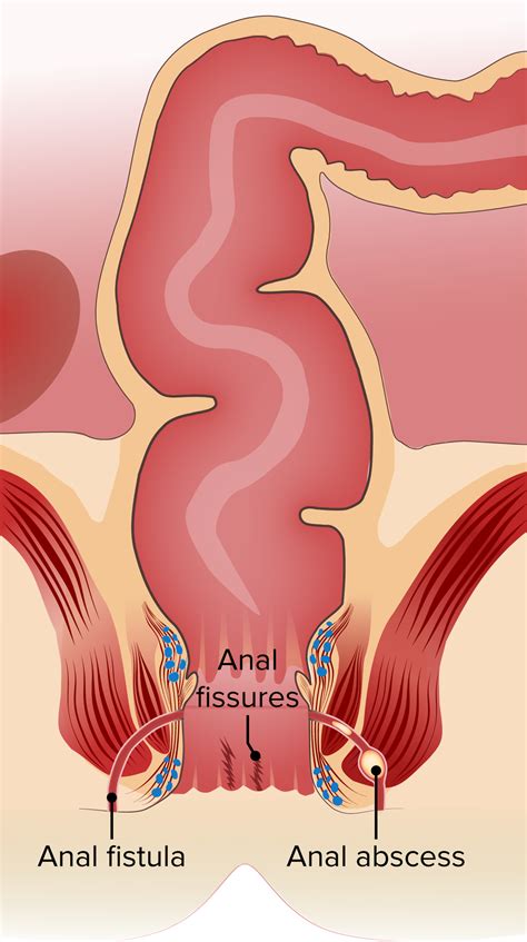 Anal Fissure Concise Medical Knowledge