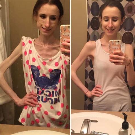 45 Before After Photos Of People Who Beat Anorexia True Activist