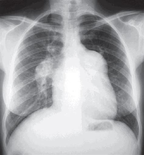 Pulmonary Artery On Chest X Ray