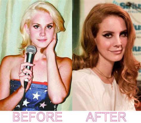 Lana Del Rey Before And After Photos Plastic Surgery Plastic Surgery