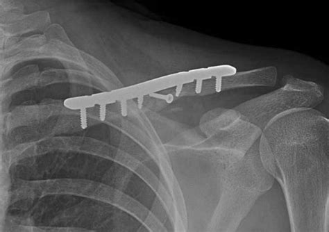 Collarbone Clavicle Fractures Hobart Orthopaedics
