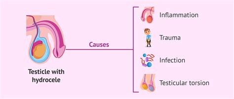 Causes Of Testicular Hydrocele