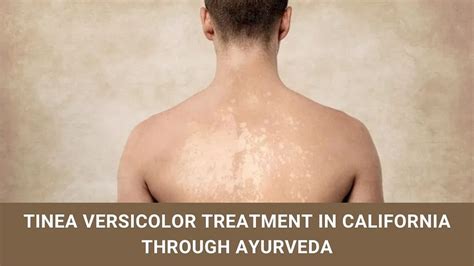 Tinea Versicolor Treatment In California Through Ayurveda