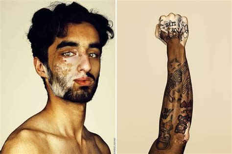 24 Images Qui Montrent Toute La Beauté Du Vitiligo Beauty Skin