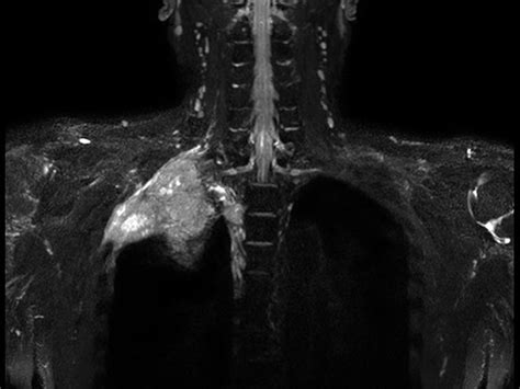 Brachial Plexus Tumor Philips Mr Body Map