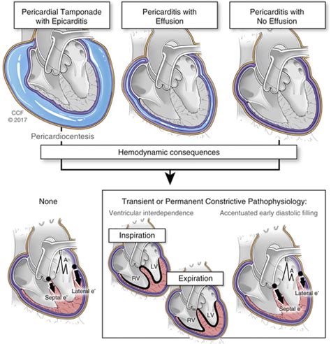 Ephemeral Effusive Constrictive Pathophysiology JACC Cardiovascular Imaging