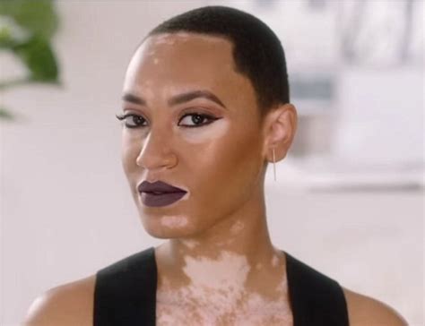 Covergirl Features Their First Black Model With Vitiligo