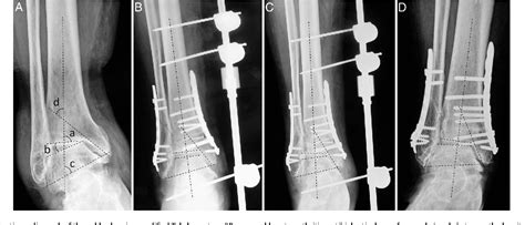 Figure 1 From Supramalleolar Osteotomy With Distraction Arthroplasty In