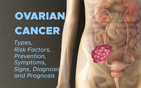 Ovarian Cancer Types Risk Factors Prevention Symptoms Signs