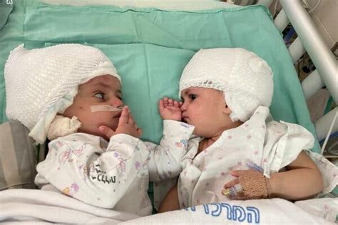 Twins Conjoined At The Head Separated In Israel The New York Times