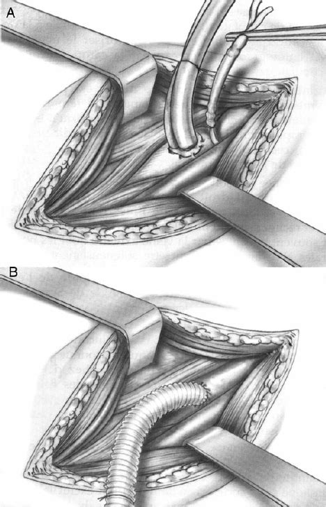 A Direct Cannulation Of The Right Axillary Artery Below The