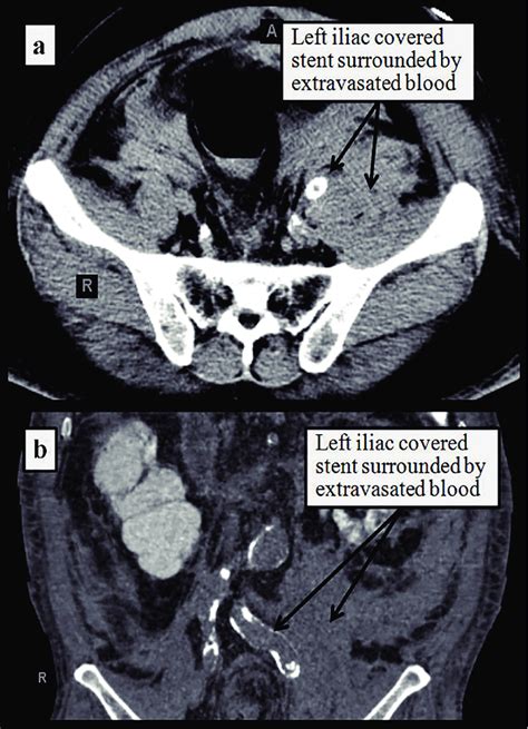 Ct Of The Abdomen Without Contrast In Transverse A And Coronal B