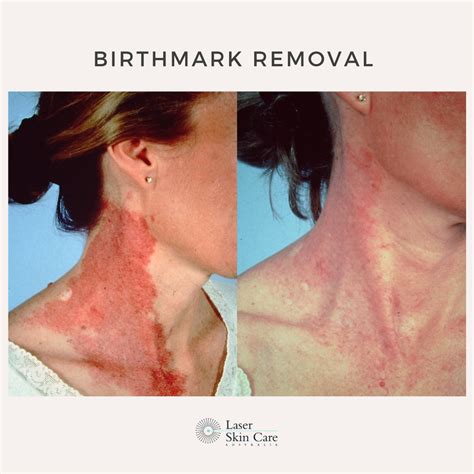 Birthmark Treatment Laser Skin Care