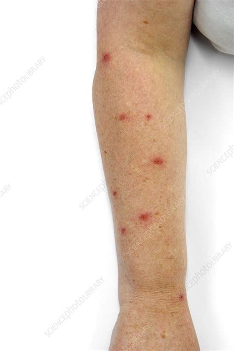 Scabies Infection On The Skin Stock Image C0183597 Science Photo