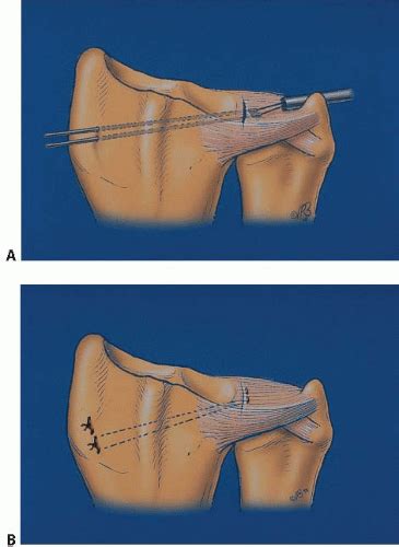 Triangular Fibrocartilage Complex Tears Arthroscopic Management