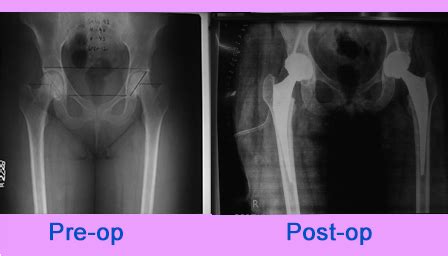 Bilateral Total Hip Replacement Sant Parmanand Hospital