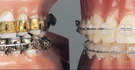 This Image Shows Fully Banded Braces Circa 1970 With Each Tooth