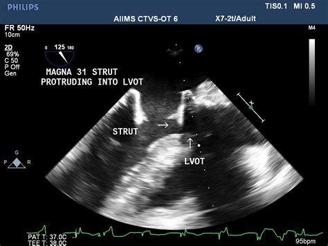 Prosthetic Mitral Valve Strut Masquerading As Left Ventricular Outflow
