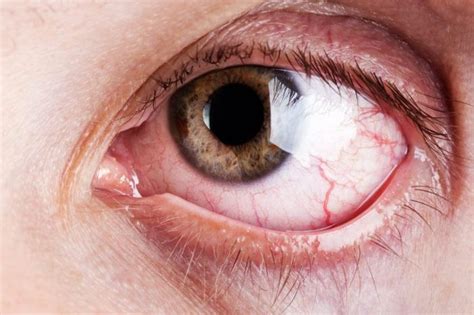 Causes Of Bloodshot Eyes And How You Can Treat Them The Healthy