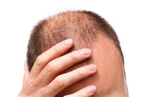 Male Pattern Baldness Symptoms Causes And Treatments