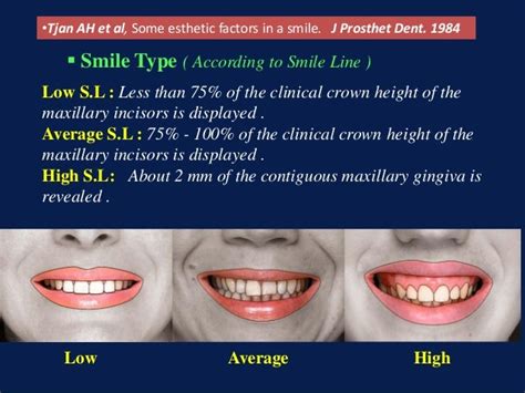 Diagnosis And Treatment Of Gummy Smile