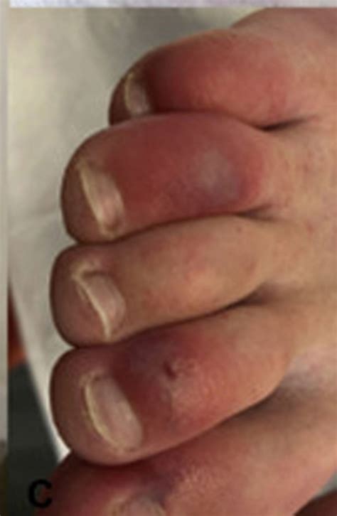 Covid Toes People With Coronavirus May Develop Skin Condition Lasting