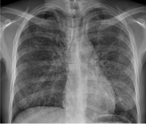 Appearances on lateral chest radiographs. Spontaneous pneumothorax in a patient with pneumocystis ...