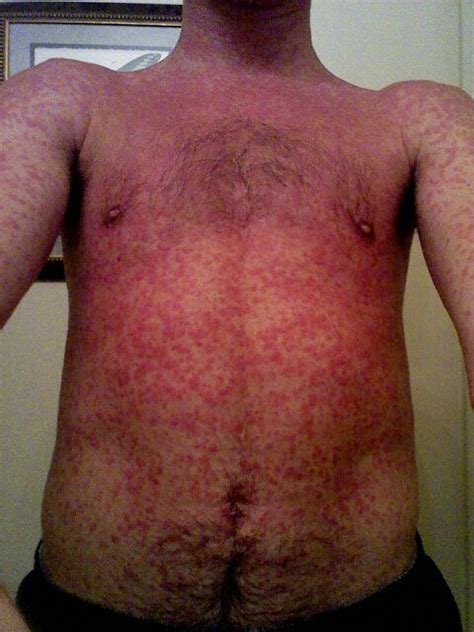 Rash Associated With Epstein Barr Virus Infection Nurse Stuff Skin